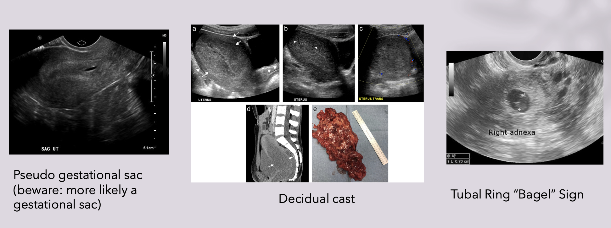 ruptured-ectopic-kwak-talk